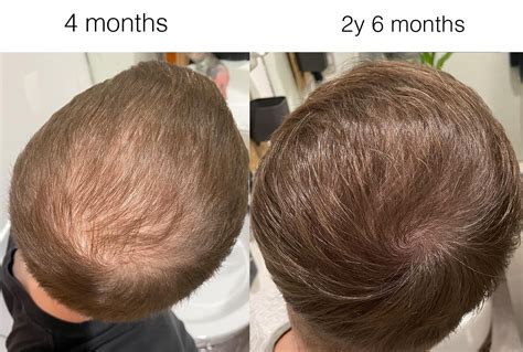 finasteride 6 months|finasteride results after 2 years.
